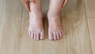 kidney disease and swollen feet